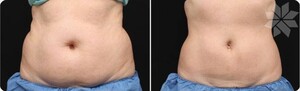 Image of Liposuction