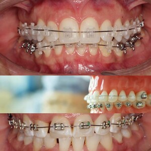 Image of Braces 