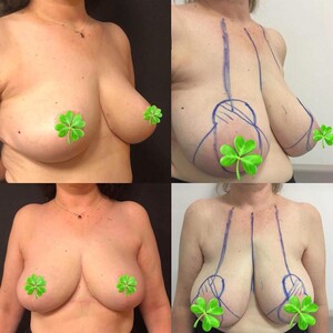 Image of Breast lift - Dr Asef Ulutürk