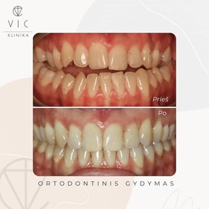 Image of Dental treatment before and after