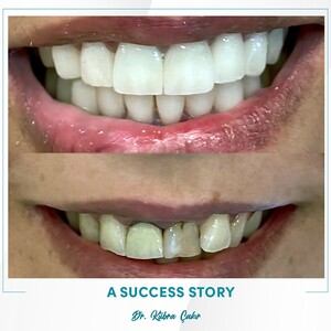 Image of Dental veneers - Dent Medica Bodrum