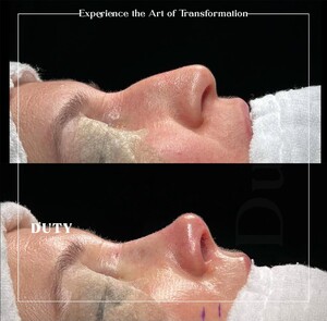 Image of Rhinoplasty