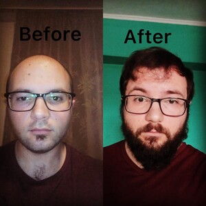 Image of Hair and Beard Transplant - Bendis Clinic