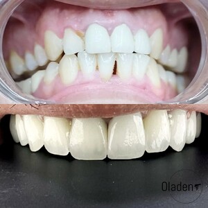 Image of Zirconium crowns before and after