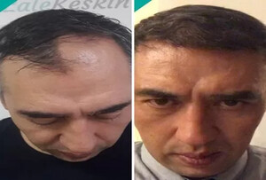 Image of Lale Hair Transplant Clinic Gallery 2