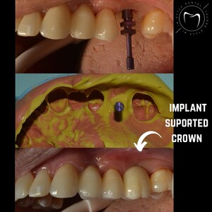 Image of Implant supported crown