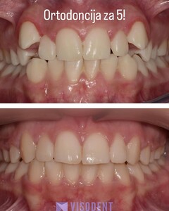 Image of Braces