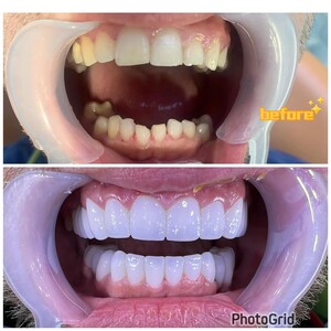 Image of Veneers - Biodent