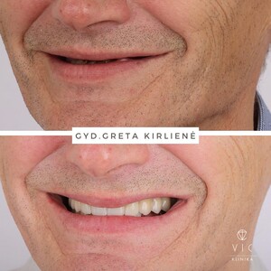 Image of Dental implants before and after