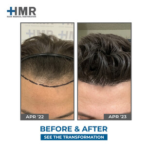 Image of Before and after hair transplant