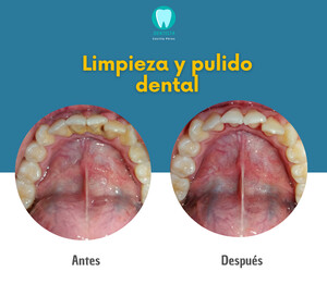 Image of Teeth cleaning