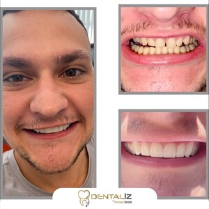 Image of smile makeover