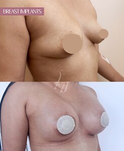 Image of Breast implants