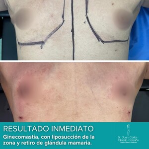 Image of Gynecomastia