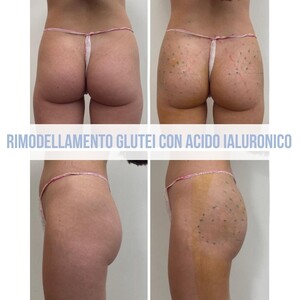 Image of Buttock Remodeling