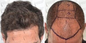 Image of Hair transplantation -  Legend Hair Transplant