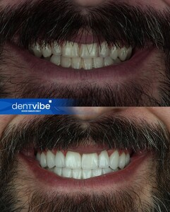 Image of Smile makeover before and after