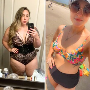 Image of Before and after gastric sleeve