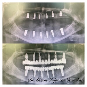 Image of Dental implants