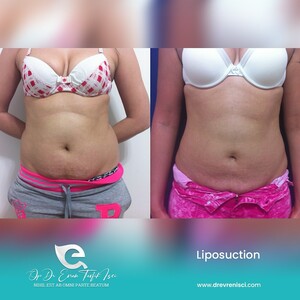 Image of VASER Liposuction