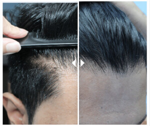 Image of Hair Transplantation Before and After