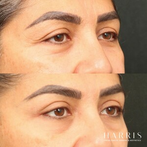 Image of Eyelid surgery