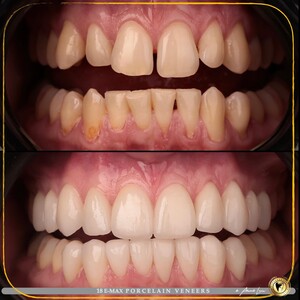 Image of Porcelain veneers -  Dr. Aleksandrs Lavrovs