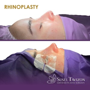 Image of Rhinoplasty