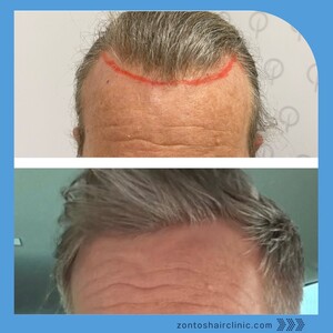 Image of Hairline restoration