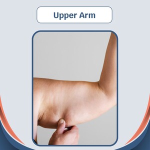 Image of Upper Arm Lift, Cauris Health