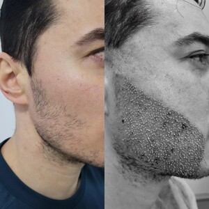 Image of Beard transplant - Arta Hair Clinic