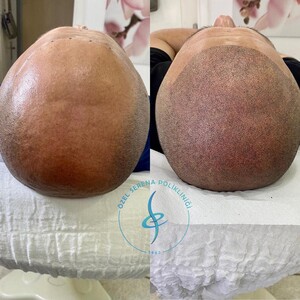 Image of Scalp micropigmentation