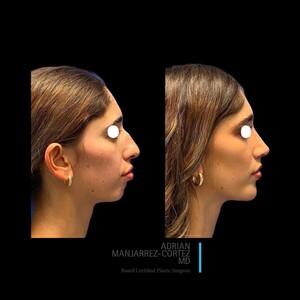 Image of Before and after rhinoplasty