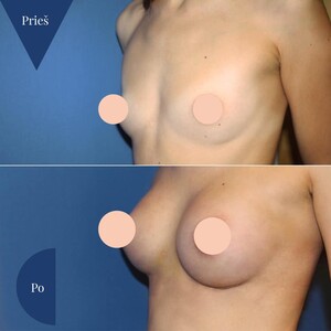 Image of Breast Implant - Vitkus Clinic