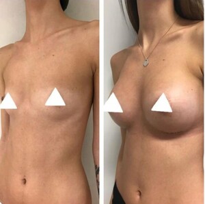 Image of Breast augmentation