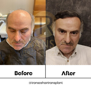 Image of Transes Hair Transplant Gallery 4