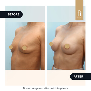 Image of Breast Implant - Fi Clinica