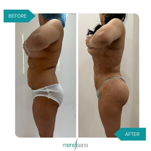 Image of Tummy tuck