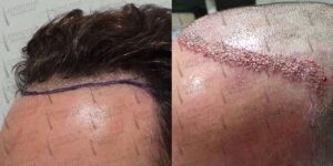 Image of DHI Hair transplant - Legend Hair Transplant