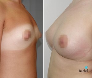 Image of Breast surgery - Barbel Polyclinic