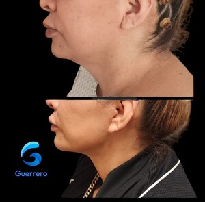 Image of Neck lift