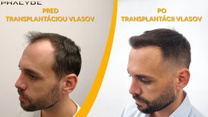 Image of Hair transplantation - Phaeyde Clinic