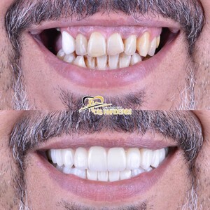 Image of Hollywood Smile -Istanbul Diş Akademisi