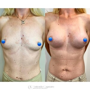 Image of Breast implants