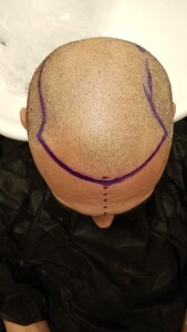 Image of Tuğba Hair Transplant Gallery 0