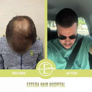 Image of Esteda Hair Hospital - Hair Transplant Turkey Gallery 3