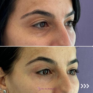 Image of Eyelid surgery