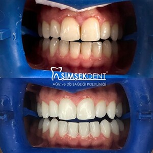 Image of Dental Treatment - Şimşek Dent