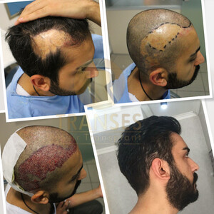 Image of Transes Hair Transplant Gallery 1