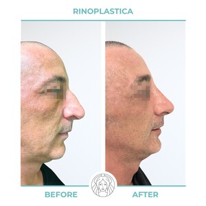 Image of Rhinoplasty - Dr Juri Tassinari